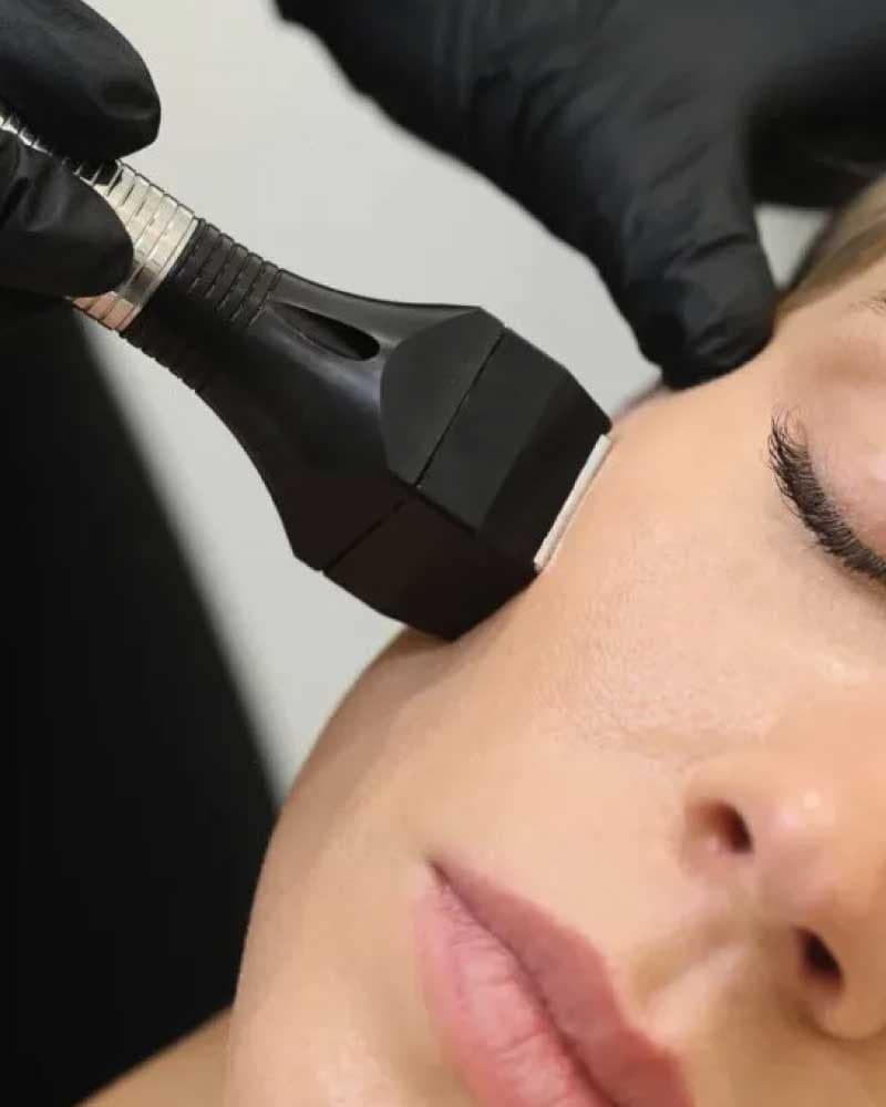 Microneedling RF